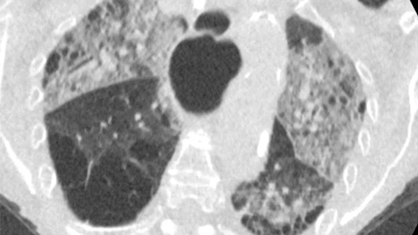 79-year-old woman with 9 days of symptoms. Scans show diffuse ground-glass opacities close to visceral pleural surfaces but superimposed on emphysematous changes. Coronavirus disease 2019 (COVID-19) Reporting and Data System (CO-RADS) score of 4. Image courtesy of RSNA. CT of Coronavirus. What does COVID look like?