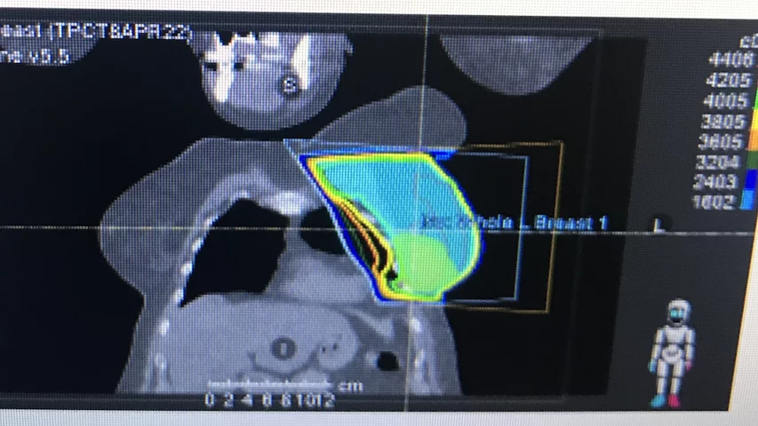 Example of an external radiation therapy treatment plan for a 73-year-old woman who had a small ductal carcinoma in situ (DCIS) surgically removed. The post-operative LINAC radiotherapy is to eliminate any cancer cells that may have been left behind from the surgery. Image courtesy of the the patient. What is breast radiation therapy? Radiotherapy for DCIS.