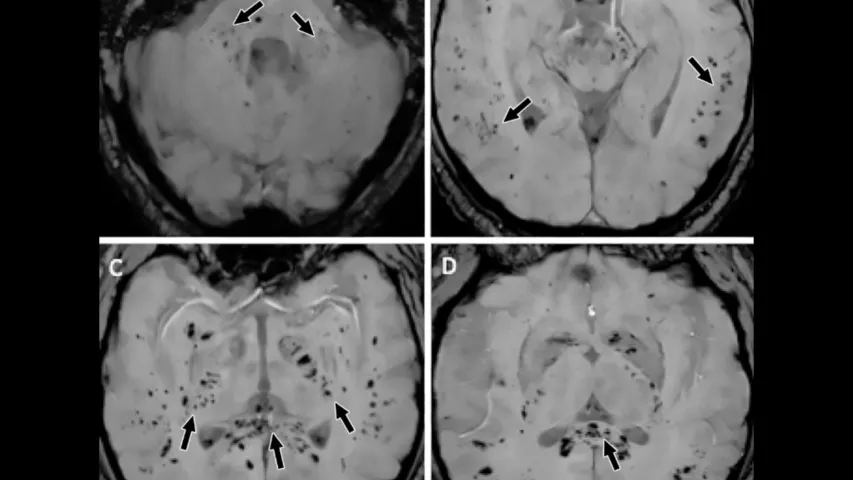 Intracranial cytokine storms can result in blood-brain barrier breakdown, but without direct viral invasion. MRI axial susceptibility-weighted images in a 57-year-old man with abnormal wakefulness after sedation show extensive and isolated white matter microhemorrhages. Image RSNA. Bleeding stroke due to COVID in imaging. Clinical imaging presentations of COVID. Clinical images of COVID. Medical imaging of COVID-19, SARS-CoV-2. What dose COVID look like on medical imaging?
