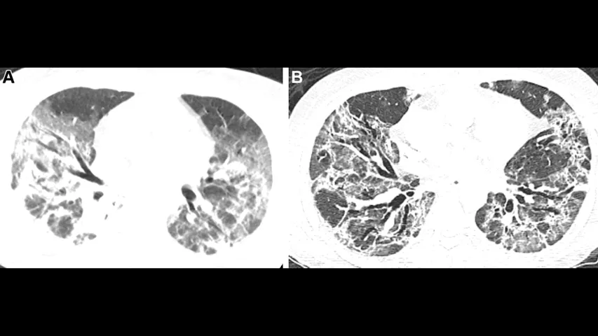 Patient with severe, lung damage from COVID. Images in a 54-year-old man with COVID-19–related acute respiratory distress syndrome and subsequent fibrosis. (A) Axial CT 2 weeks after admission shows diffuse ground-glass opacity (GGO) with reticular abnormality and traction bronchiectasis in right middle lobe, indicating organizing phase of lung injury. (B) Axial CT 6 months after admission shows decreased GGO but extensive traction bronchiectasis and architectural distortion, suggesting fibrosis. RSNA