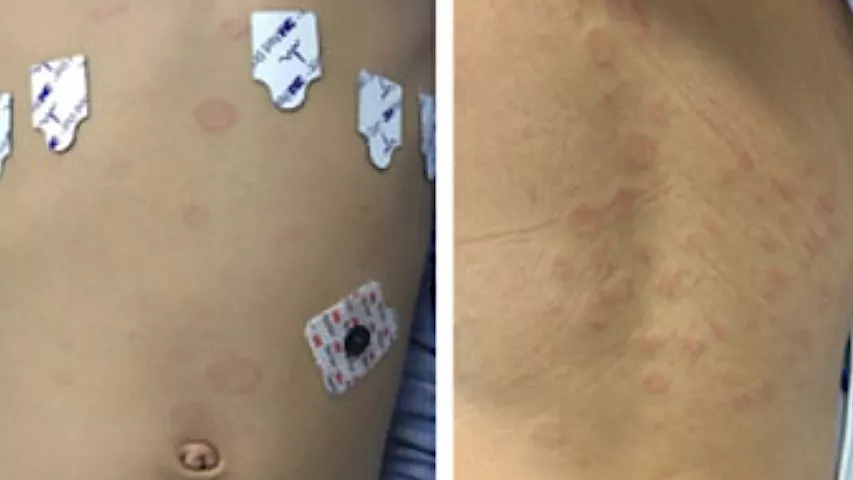 Rash caused by hyperinflammation caused by the post-infectious complication of COVID infection, multi-system inflammatory syndrome in children (MIS-C). Annular plaques on the torso (L) and back (R) of a patient with MIS-C. The syndrome effects a very small percentage of pediatric patients infected with COVID, including those who had completely asymptomatic infections. What does MIS-C look like? Children’s Hospital of Philadelphia. What does COVID look like? Images of COVID clinical presentations.