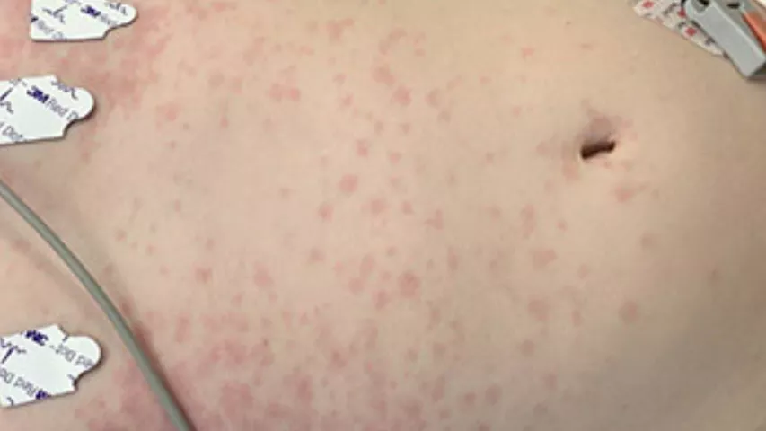 Rash on the torso of a pediatric patient with multi-system inflammatory syndrome in children (MIS-C). The rash is caused by hyperinflammation caused by the post-infectious complication of COVID infection. The syndrome effects a very small percentage of pediatric patients infected with COVID, including those who had completely asymptomatic infections. What does MIS-C look like? COVID clinical imaging. Children’s Hospital of Philadelphia