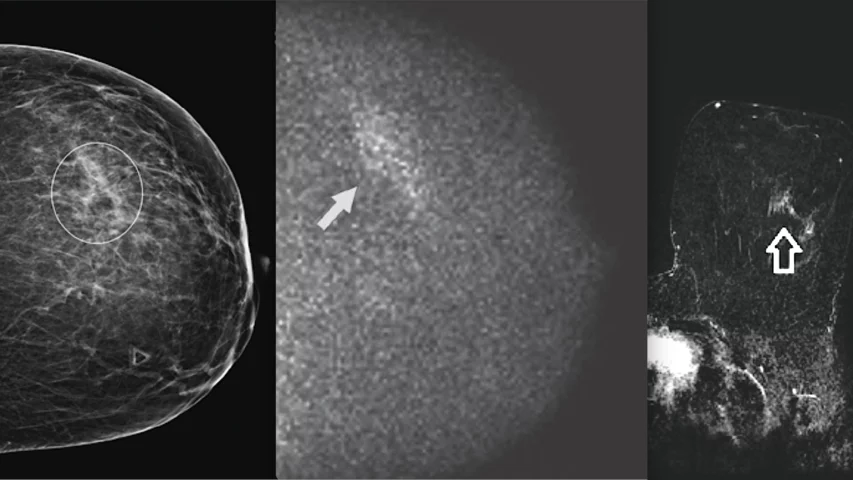 39-year-old woman with an abnormal baseline screening mammography result. Molecular breast imaging (MBI) was performed for problem-solving. Left, diagnostic mammography shows asymmetry in the outer left breast, middle depth (circle). Middle, molecular breast imaging (MBI) shows a segmental area of nonmass uptake with mild intensity in the outer left breast, middle depth (arrow), that corresponds with the mammographic asymmetry. Right, breast MRI. AJR Image