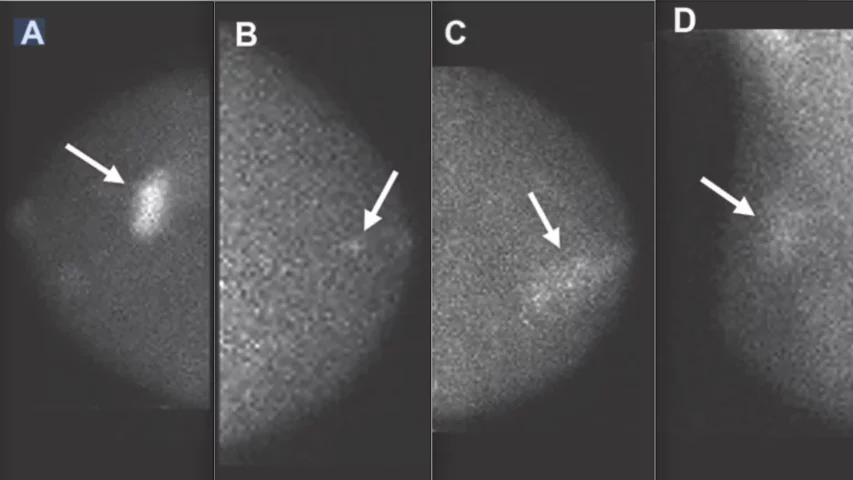 Images from molecular breast imaging (MBI) examinations demonstrating MBI lexicon descriptors. A, Mass (arrow) with marked intensity of uptake. B, Nonmass uptake (arrow) with focal distribution and mild intensity of uptake. C, Nonmass uptake (arrow) with segmental distribution and moderate intensity of uptake. D, Nonmass uptake (arrow) with regional distribution and mild intensity of uptake. Images courtesy of AJR.