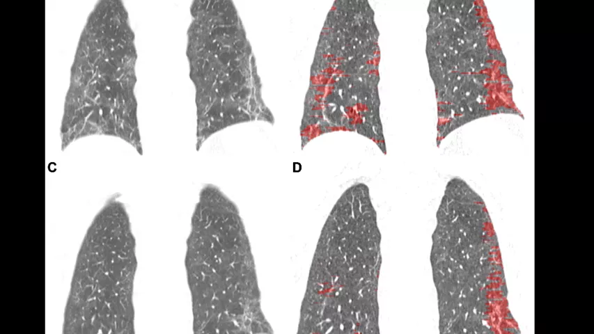 Images depict quantitative CT assessment of linear and reticular abnormality following COVID-19 acute respiratory distress syndrome in a 59-year-old woman. (A) CT obtained 10 weeks after infection shows ground-glass opacity with linear and reticular abnormality at both bases. (B) Corresponding quantitative CT delineates linear and reticular abnormality, quantified at 10.5% of lung volume. (C) Four months later. (D) Corresponding quantitative CT indicates linear and reticular abnormality, now 4.6%. RSNA