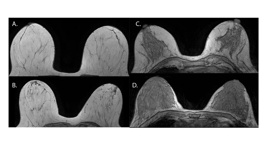 Mammographic density translates into fibroglandular tissue quantity. These examples show what breast density looks like on MRI imaging. Axial nonenhanced T1-weighted MR images show the following descriptors: A. almost entirely fat, B. scattered fibroglandular tissue, C. heterogeneous fibroglandular tissue, and D. extreme fibroglandular tissue. RSNA Images. What do dense breasts look like on MRI?