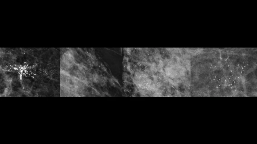 Examples of mammogram calcifications with suspicious morphology. These images are zoomed in to show calcifications with increasing risk for malignancy: coarse heterogeneous (far left), amorphous (second from left), fine pleomorphic (second from right), and fine linear or fine linear branching (far right). Image courtesy of RSNA. What are microcalcifications on a mammogram?