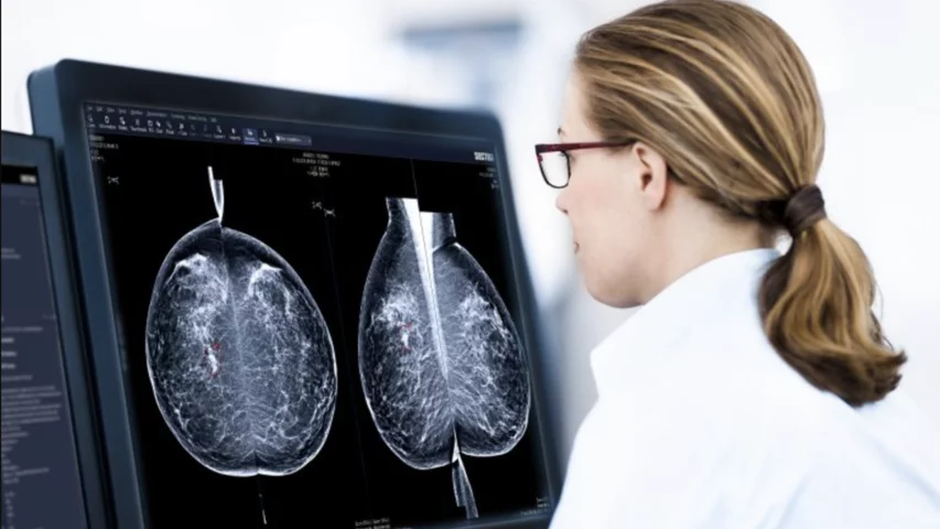 Radiologist reading a mammogram exam. Two different views of of the breast are taken and the images of the left and right breast are placed side by side for comparison. A woman's breasts are generally symmetrical, so the side-by-side comparison helps with a quick comparison to pick out anomalies that might be cancer. Image courtesy of Sectra. What does a mammogram look like?