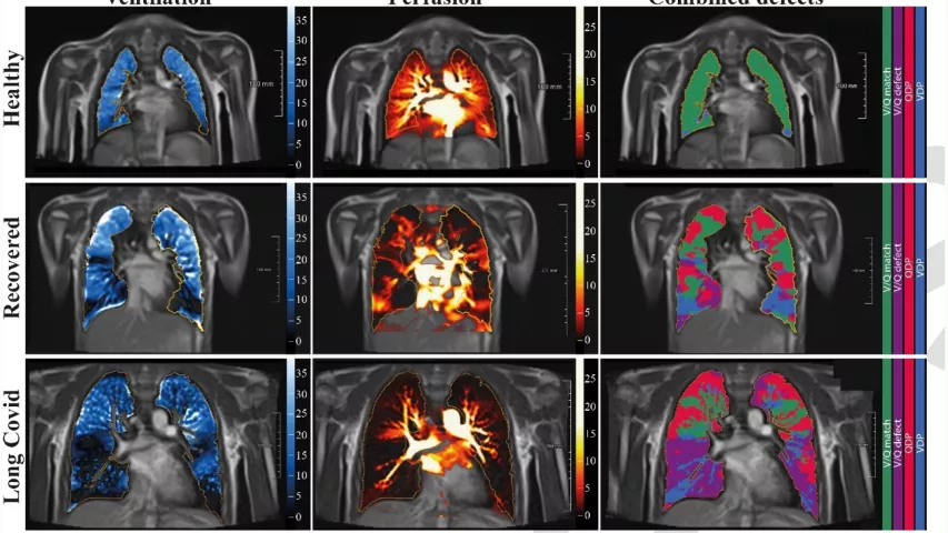 Long-COVID lung damage in children. A new analysis published in Radiology details signs of persistent pulmonary dysfunction in children who have recovered from a COVID infection or who are experiencing symptoms of long-COVID. Using low-field MRI, experts found reduced ventilated and perfused lung parenchyma (V/Q match) in the COVID group of patients compared to a group of healthy controls. Photo from RSNA