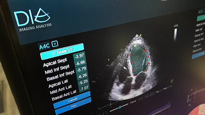 Strain cardiac echo imaging has become a hot topic in cardiac ultrasound and many cardiologists now see utility with the additional clinical information it can provide to inform care decisions. However, it can be time consuming and many centers have low usage of strain, even if they have strain packages on their systems. Dia showed an automated strain AI application at RSNA this year aimed at automating the process to increase strain usage.  #RSNA #RSNA22