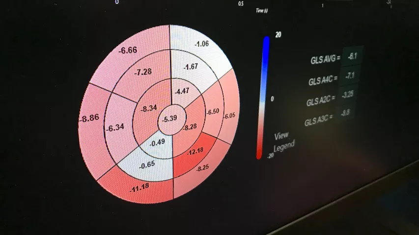 Automated bullseye plot of strain deficits in the myocardium detected by Dia's AI enabled, automated echocardiogram strain software. 