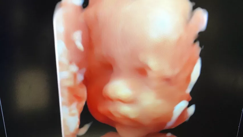 Fetal 3D ultrasound face shown by the vendor Alpinion. The company also OEMs its technology to some of the bigger vendors on the floor.  Fetal imaging. Example of a baby ultrasound. RSNA22 #RSNA. Foetus ultrasound.