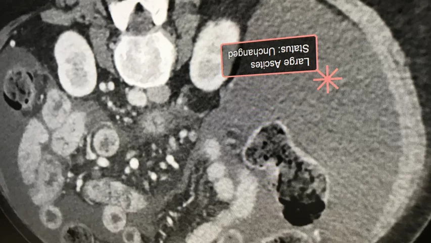 AI identification of live ascites using the AI Metrics technology. The AI was cleared by the FDA in December 2020.