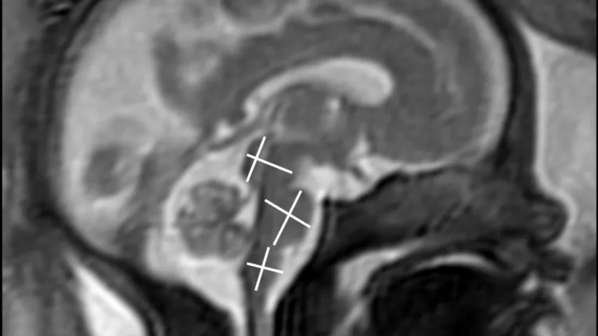 MRI image to assess fetal brain development. Image courtesy of RSNA. Baby brain on MRI. Fetal imaging.