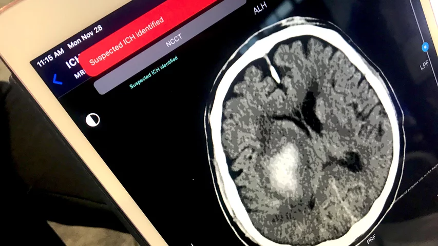 Example of an artificial intelligence (AI) automated notification on an iPad alerting a stroke alert team that a intracranial hemorrhage (ICH) stroke has been detected. These alerts can help speed review by a radiologist and treatment for the patient. This was demonstrated using Terarecon's system at RSNA 2022. What does a brain hemorrhage, bleeding stroke, look like on medical imaging?