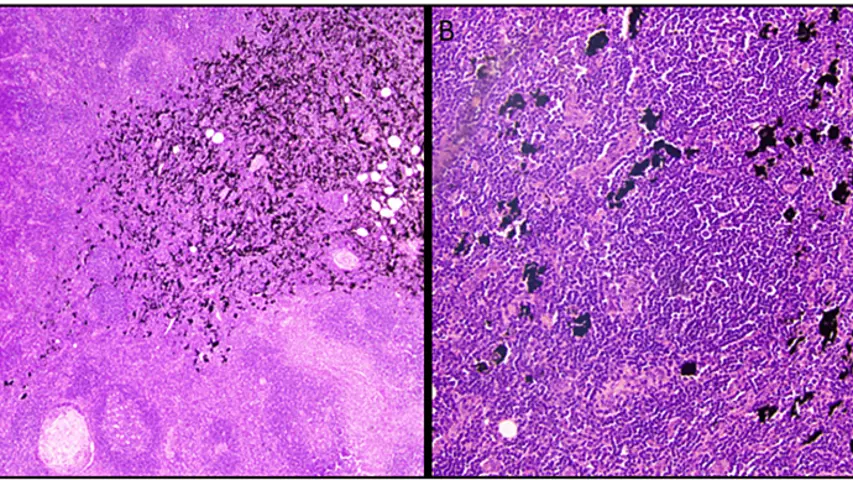 tattoo ink causes lymphadenopathy