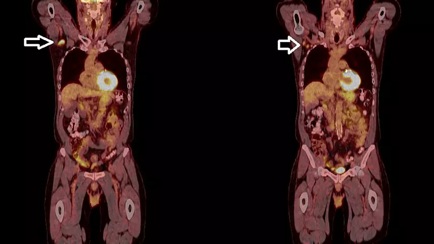 tattoo causes lymphadenopathy