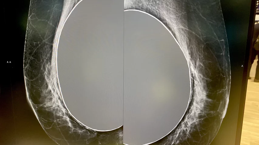 Breast implants on mammography, part of a breast imaging workstation demo in the Sectra booth at HIMSS23.