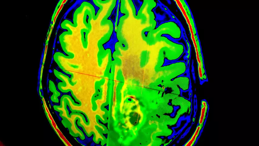 MRI brain perfusion image showing blood flow in the brain and an anomaly in flow in the lower right. Image shown on a Sectra PACS at HIMSS 2023. Photo by Dave Fornell