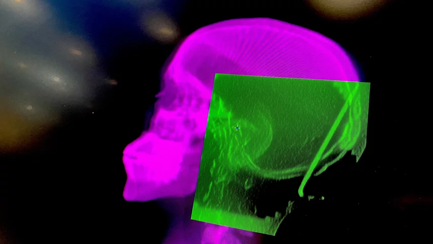 Radiation therapy treatment plan and onboard imaging registration image before each fraction, from the Elekta Mosaiq oncology information system displayed at HIMSS23.