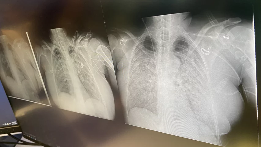 Serial x-ray exams side by side for comparison of patient progress. Sectra PACS HIMSS 2023.