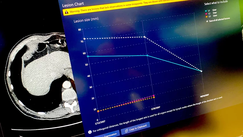 Tumor tracking feature of Sectra enterprise imaging system to more clearly show tumor regression or growth on serial exams. HIMSS23