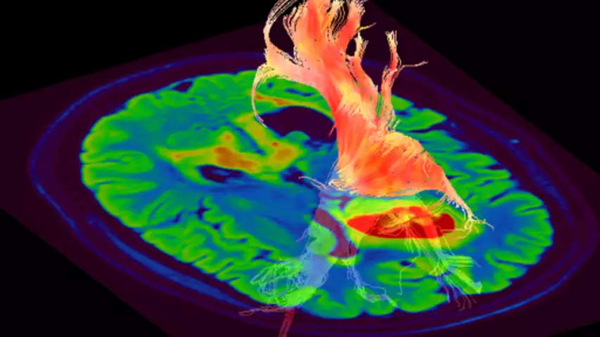 Brain MRI tractography image from a GE 48 channel head coil SIGNA FLAIR Cube Fusion. GE RSNA PR image