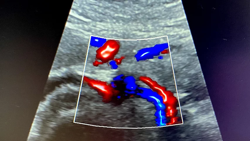 New-look 3D Doppler blood flow using the the Philips Epiq ultrasound system at RSNA 2023. Photo by Dave Fornell #RSNA #RSNA23 #RSNA2023