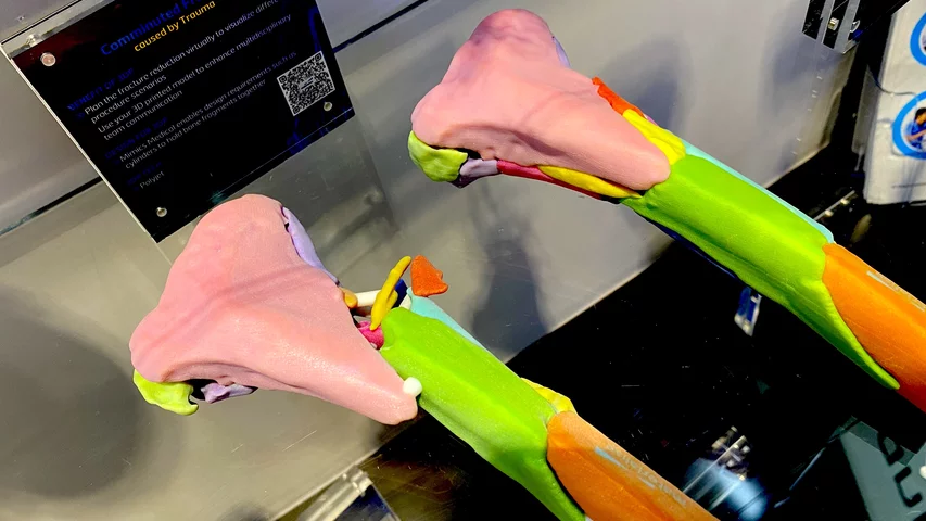 3D printed fracture of both femurs from CT scan to aid reconstructive orthopedic surgery, displayed by Materialise at RSNA 2023. DF#RSNA #RSNA23 #RSNA2024