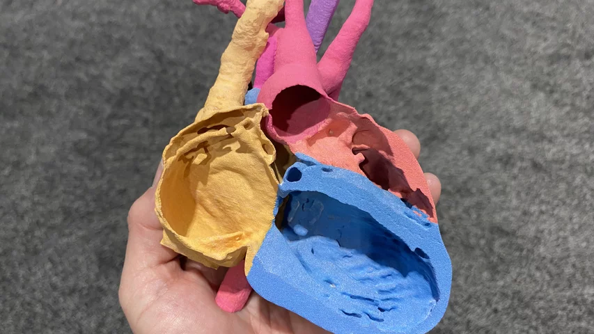 3D printed congenital single ventricle patient from a CT scan, displayed at RSNA 2023 by Medviso. Models like this can help in surgical preplanning and peri-procedural guidance.#RSNA #RSNA23 #RSNA2024 #SCAI