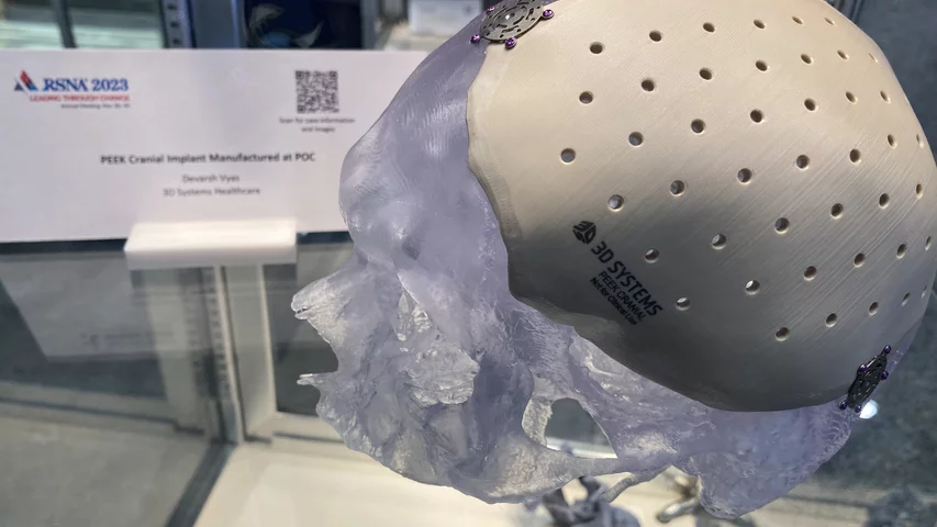 3D printed PEEK cranial implant. Photo by Dave Fornell. #RSNA #RSNA23 #RSNA2023