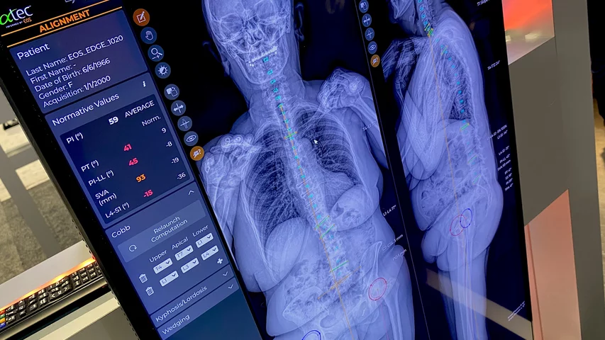 AI automated orthopedic measurements on the EOS load bearing X-ray system at RSNA 2023. Photo by Dave Fornell. #RSNA #RSNA23 #RSNA2023 orthopedic imaging
