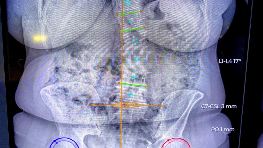 AI automated orthopedic measurements on the EOS load bearing X-ray system at RSNA 2023. Photo by Dave Fornell. #RSNA #RSNA23 #RSNA2023 orthopedic imaging