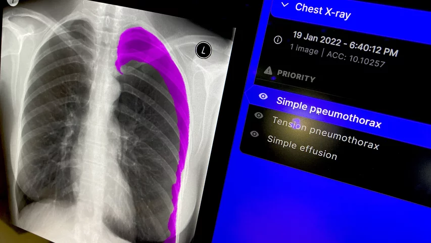 AI detected pneumothorax collapsed lung shown by Annalise at RSNA 2023. Photo by Dave Fornell. #RSNA #RSNA23 #RSNA2023