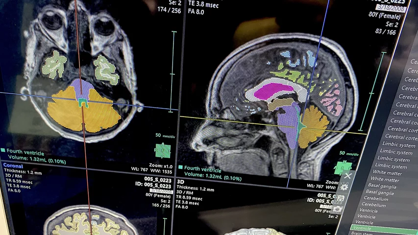 Brain MRI AI assessment and segmentation on Fujifilm's Synapse system at RSNA 2023. Photo by Dave Fornell. #RSNA #RSNA23 #RSNA2023