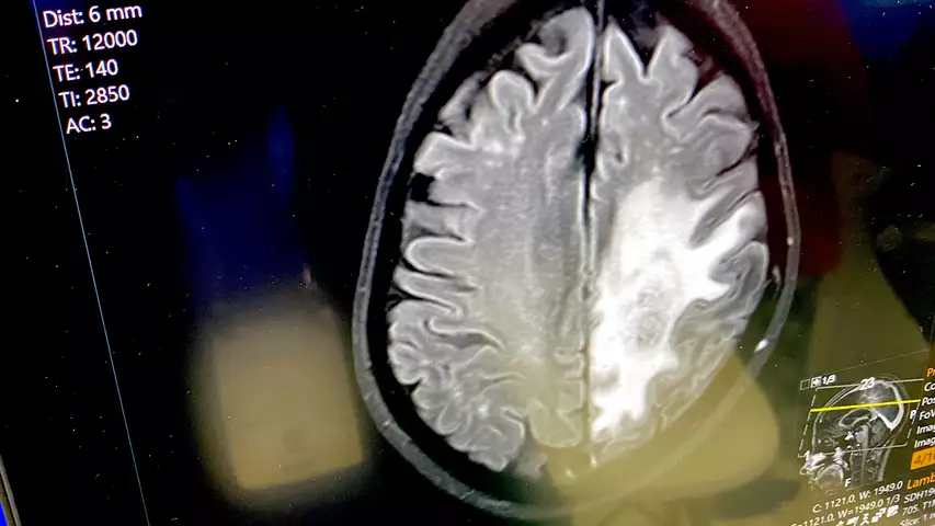 Brain CT scan showing glioblastoma brain cancer tumor. Tumors usually have much higher metabolism that normal tissues, so there is an increased uptake of contrast agents that enhance the tumor. Example on the Sectra PACS at RSNA 2023.  Photo by Dave Fornell #RSNA #RSNA23 #RSNA2023