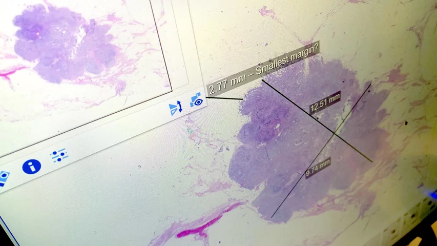 Example of a digital pathology breast specimen slides in the Sectra enterprise imaging system at RSNA 2023. Photo by Dave Fornell #RSNA #RSNA23 #RSNA2023 #Digitalpathology