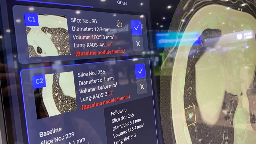Automated Lung CT AI nodule detection and assessment, showing serial exams for a patient undergoiung therapy and the CT measurements used to see if the tumor is growing of shrinking. Vuno Med LungCT AI. Photo by Dave Fornell. #RSNA #RSNA23 #RSNA2023 orthopedic imaging