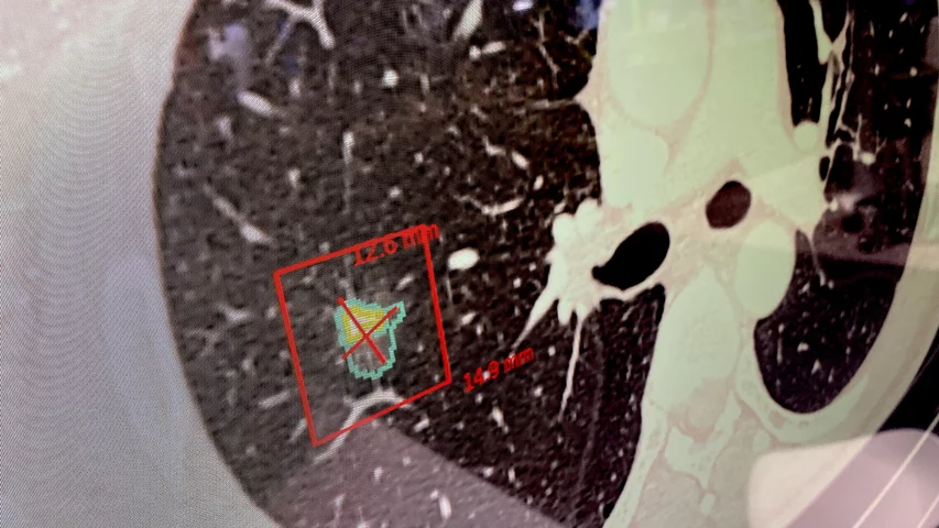 Lung CT AI nodule detection using the Vuno Med LungCT AI algorithm. Photo by Dave Fornell. #RSNA #RSNA23 #RSNA2023 orthopedic imaging