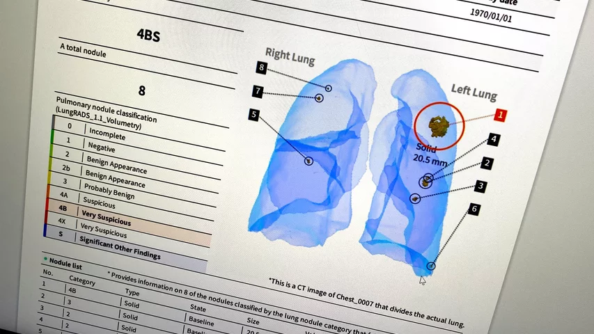 Lung CT low-dose lung screening using AI lung nodule detection, shown by CoreLine at SCCT 2023. Photo by Dave Fornell