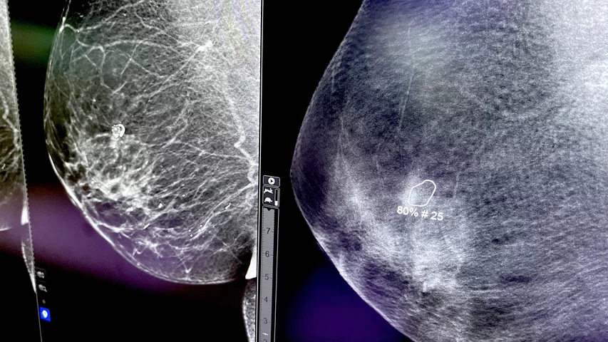 Mammography 2D and tomosynthesis 3D with cancer spotted by iCAD AI GE Pristina Bright RSNA23.