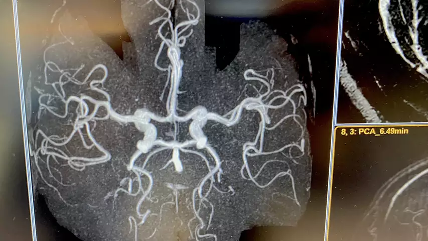 MRI showing blood vessels in the brain enhanced with gadolinium contrast. This type of imaging can show stroke, vascular malformations, aneurisms, cerebral hemorrhages and highlight tumors with vascular networks. Imaged on a Philips Blue Seal 1.5T system. Brain MRI images of a Philips Blue Seal 1.5T system. #RSNA #RSNA23 #RSNA2024