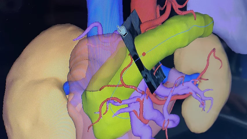 Pancreas CT image segmentation and assessment on the Fujifilm Synapse PACS at RSNA 2023. Photo by Dave Fornell. #RSNA #RSNA23 #RSNA2023 orthopedic imaging