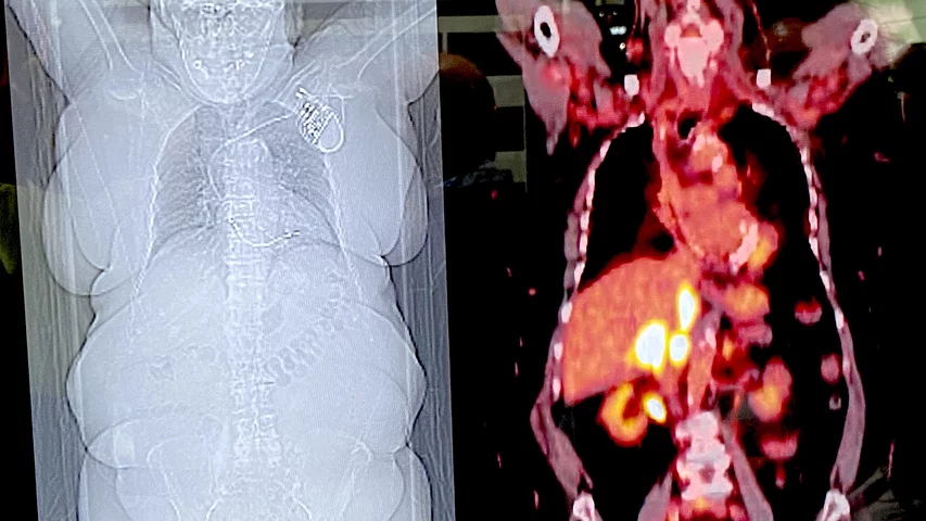 Example of the image quality for digital detector, time-of-flight PET-CT imaging of an adrenal mass in an obese cancer patient using the Siemens Biograph Vision X system. Photo by Dave Fornell. #RSNA #RSNA23 #RSNA2023