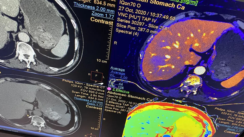 Spectral CT stomach cancer and liver iodine density and Z effective in Philips booth RSNA 2023. Photo by Dave Fornell. #RSNA #RSNA23 #RSNA2023