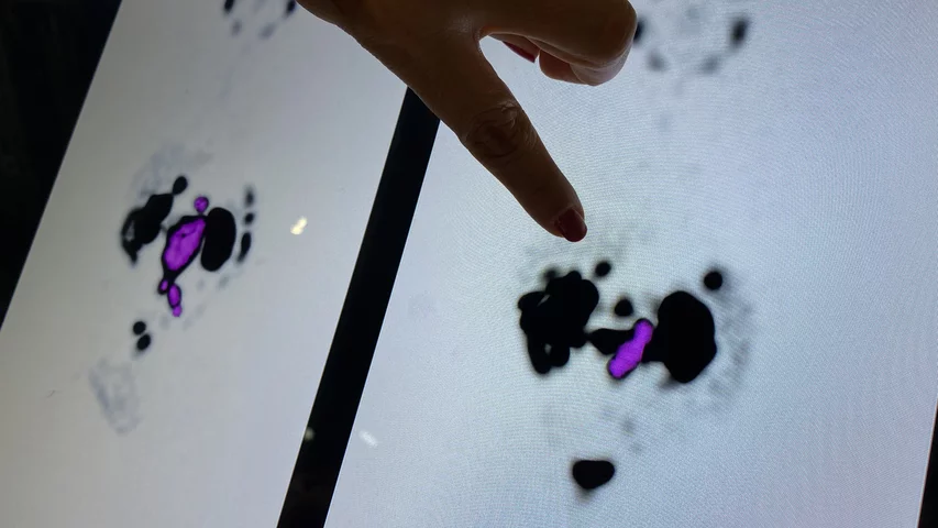 Theranostic for prostate cancer showing regression of tumor at Siemens booth RSNA 2023. Photo by Dave Fornell. #RSNA #RSNA23 #RSNA2023