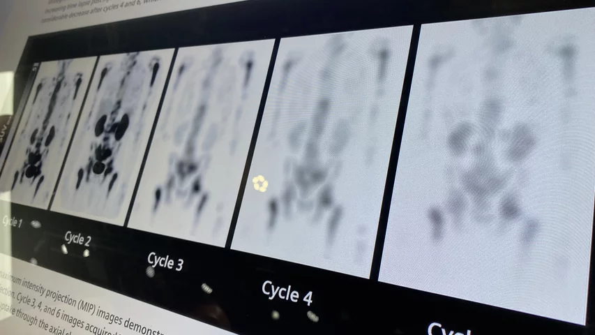 Theranostic for prostate cancer showing regression of tumor at Siemens booth RSNA 2023. Photo by Dave Fornell. #RSNA #RSNA23 #RSNA2023