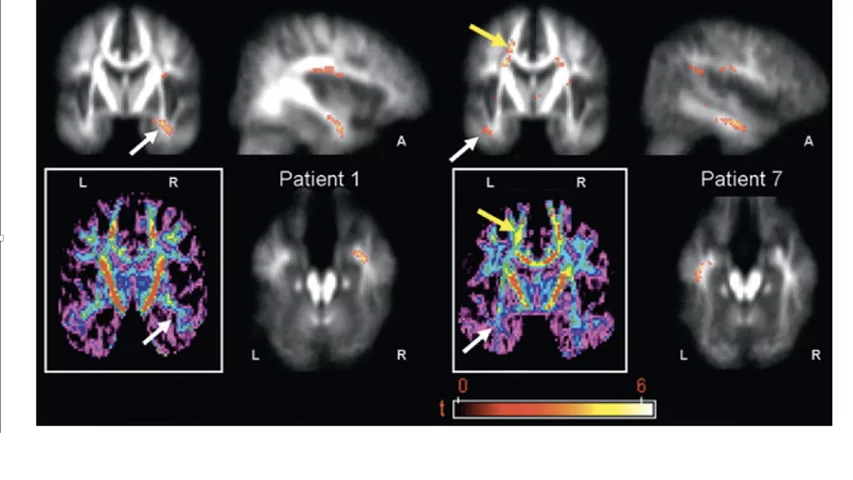 Epilepsy seen in MRI post-processing to show the epileptogenic zone (EZ) location. Focal epilepsy is a common and severe neurologic disorder and neuroimaging aims to identify the EZ. For about a third of patients with chronic drug-resistant focal epilepsy, the EZ cannot be precisely identified using standard 3.0-T MRI. Computational image processing can aid radiologic assessments and increase the success rate of uncovering suspicious regions by enhancing their visual conspicuity. Image courtesy off RSNA.