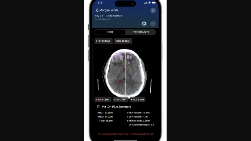 Viz.ai ICH Plus gains FDA approval. The AI obtains accurate and quantifiable measurements of intracerebral hemorrhages through Viz ICH Plus significantly enhances our decision-making process.