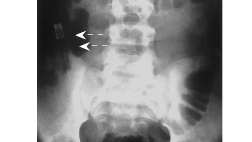Radiograph shows a pencil (arrows) lodged in the ascending colon. It passed without difficulty, which is unusual for such an elongated object to pass through the intestinal tract without problems. Courtesy of RSNA https://pubs.rsna.org/doi/10.1148/rg.233025137